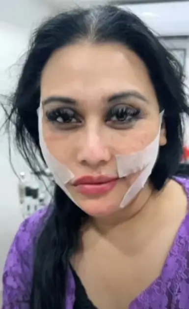 Blue Fairy Laila facial cosmetic surgery